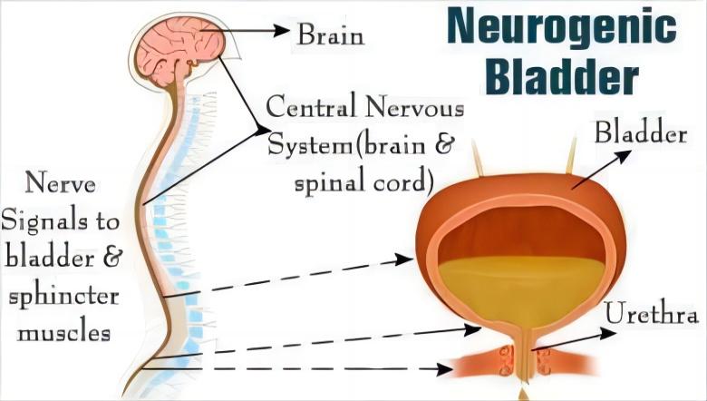 羽豐醫(yī)療丨簡易盆底振動(dòng)治療神經(jīng)源性膀胱